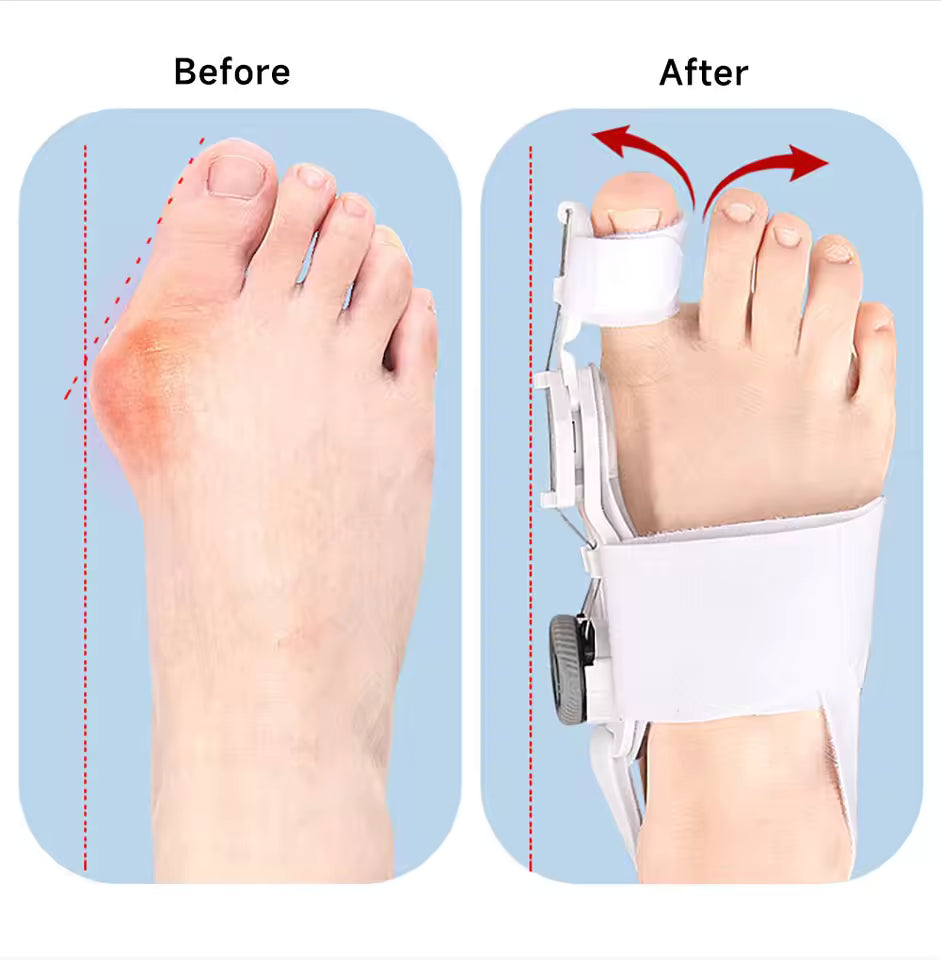 Adjustable Bunion Toe Corrector