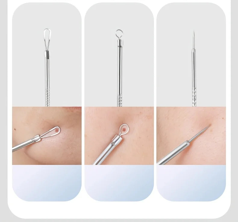 Professional Acne Removal Kit