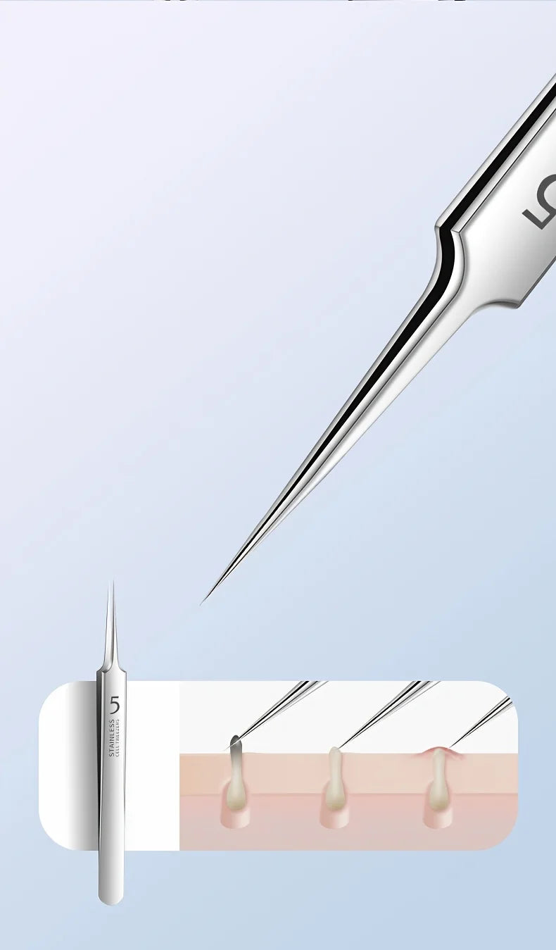 Professional Acne Removal Kit